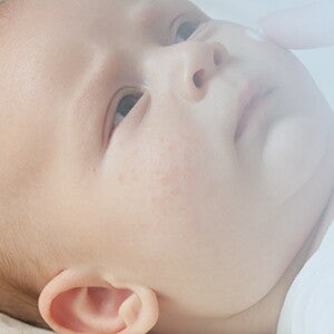 Fragen und Antworten zu Allergien bei kleinen Babys. 